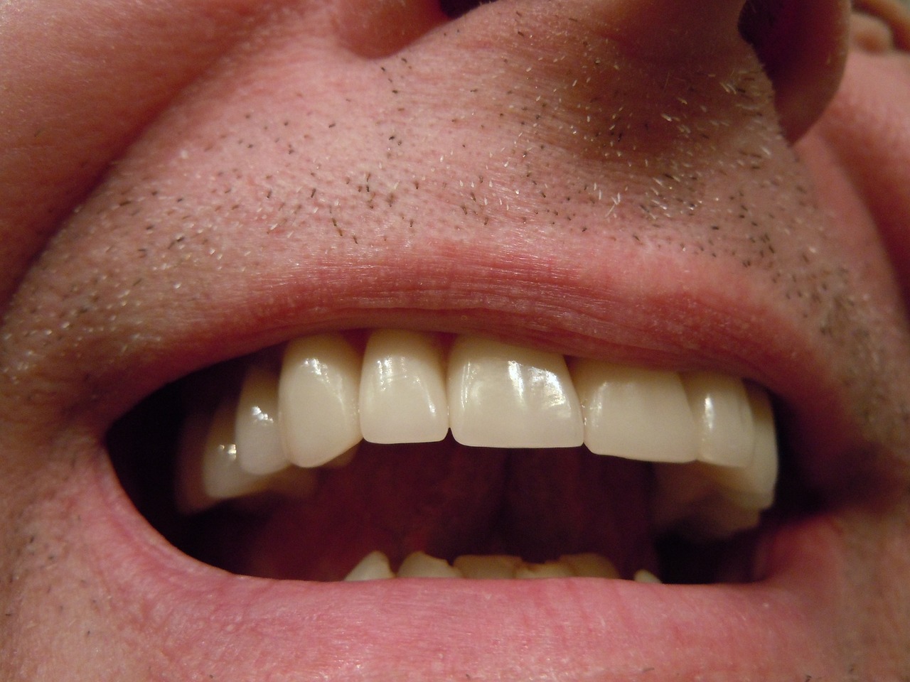 Ankara Ortodonti Uzmanı - İnvisalign Plaklarının Temizliği