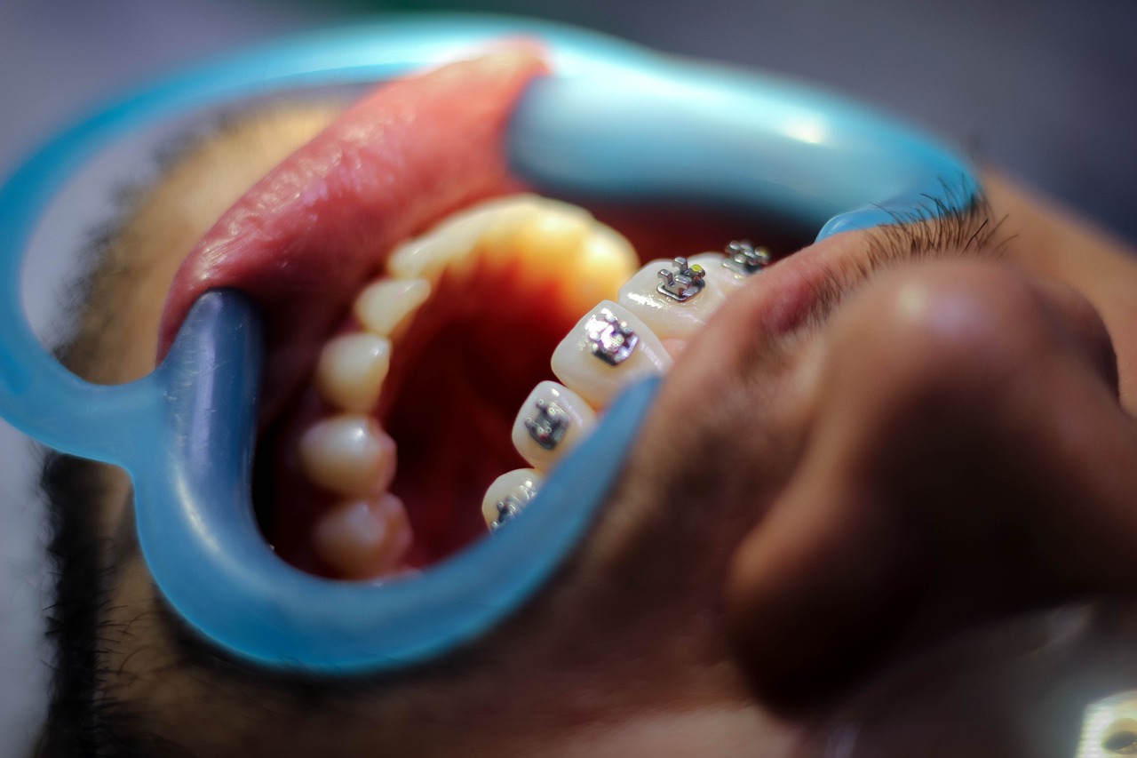 Ankara İnvisalign Doktor - Invisalign ve Sabit Retainer: Hangisi Daha İyi Gece Kullanımı İçin Uygun?