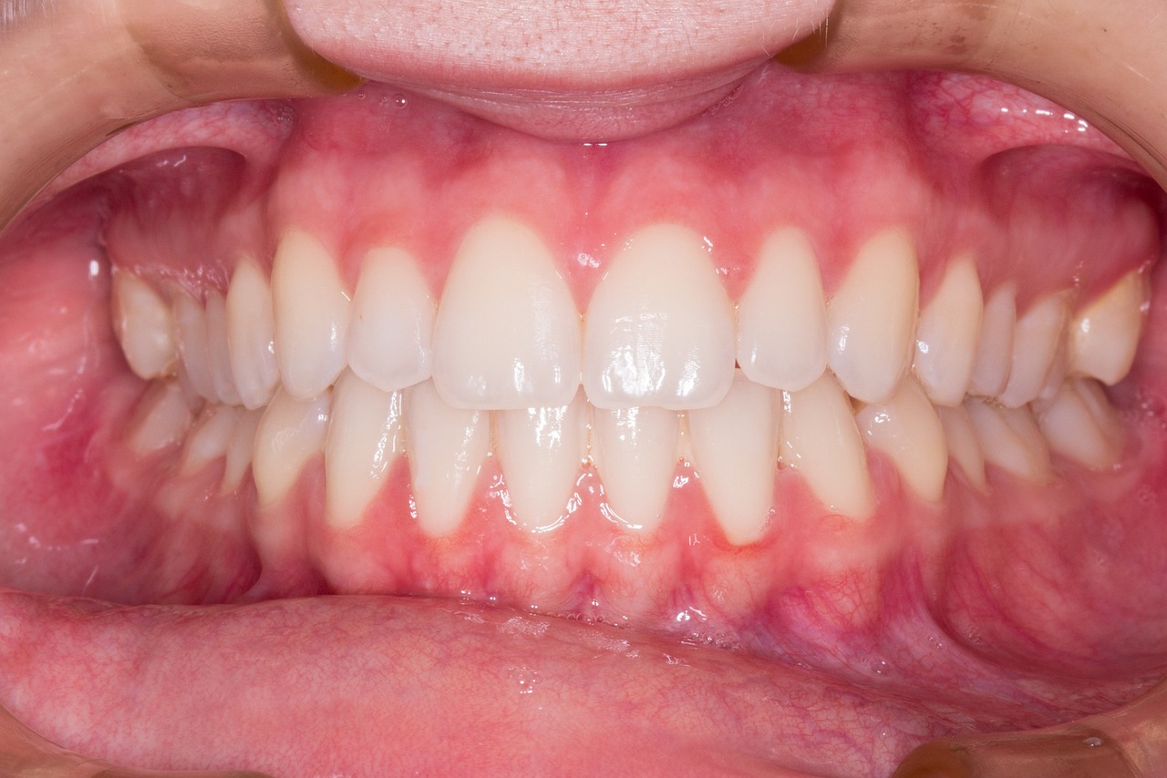 Ankara İnvisalign Klinik - Invisalign mı, Sabit Retainer mı? Hangisi Daha Hızlı Sonuç Verir?